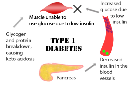 insulin dependent diabetes